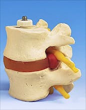 2 Vertebras Lumbares con Hernia de Disco