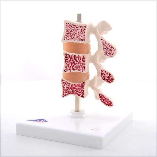 Modelo de Osteoporosis, 3 Vertebras