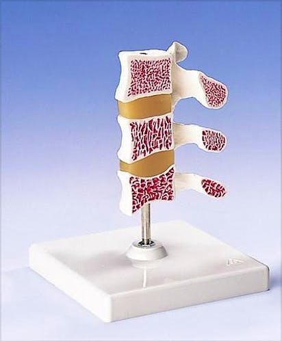 Modelo de Osteoporosis, 3 Vertebras