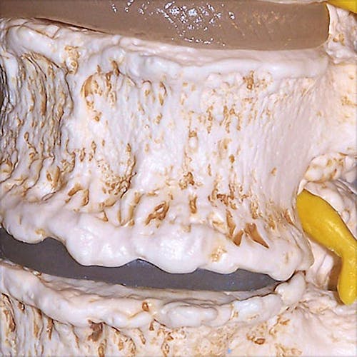 Estadios del Prolapso del Cartílago Intervertebral y de la Degeneración