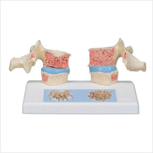 Modelo de Osteoporosis
