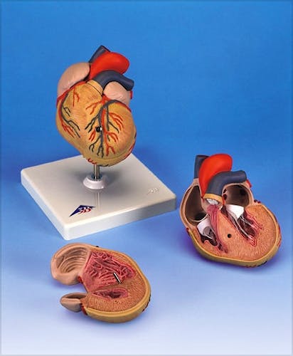 Corazon con Ventriculo Izquiero Hipertrofiado