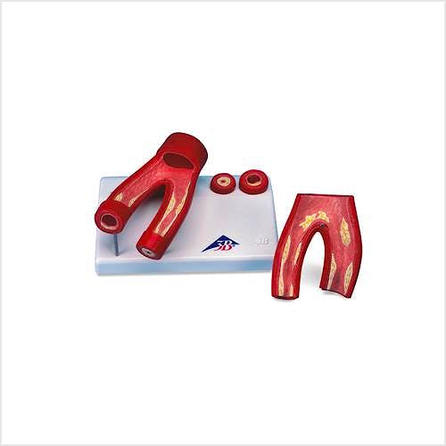 Modelo de Arteriosclerosis con Corte Transversal Arteria 2 Partes