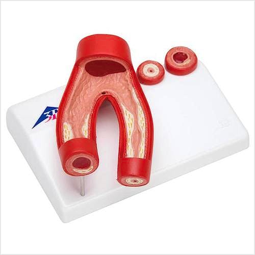 Modelo de Arteriosclerosis con Corte Transversal Arteria 2 Partes