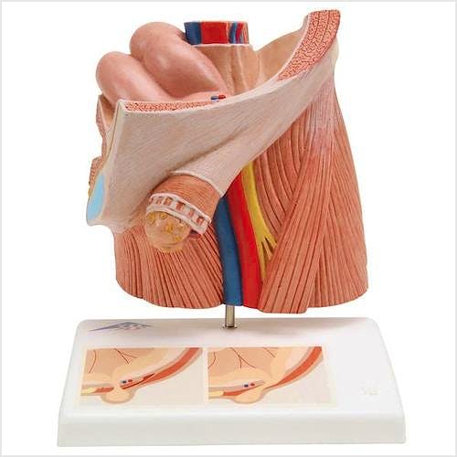 Modelo de Hernia Inguinal
