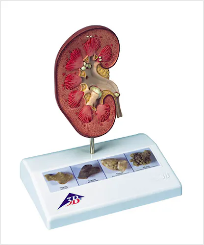 Modelo de Calculo Renal
