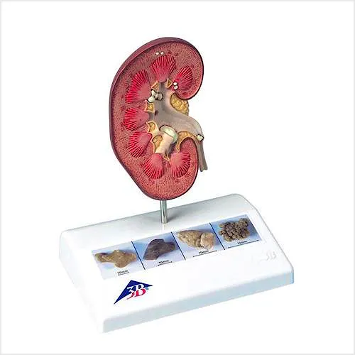 Modelo de Calculo Renal