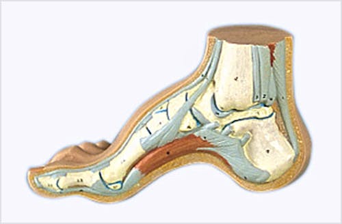 Pie Arqueado (Pes Cavus)