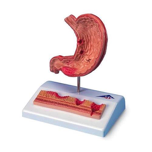 Estómago con Úlceras Gástricas