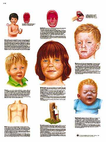 Lamina Enfermedades de la Infancia (formato 50 x 67 cm)