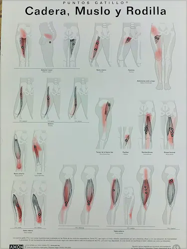 Lámina Puntos Gatillo: Cadera, Muslo y Rodilla