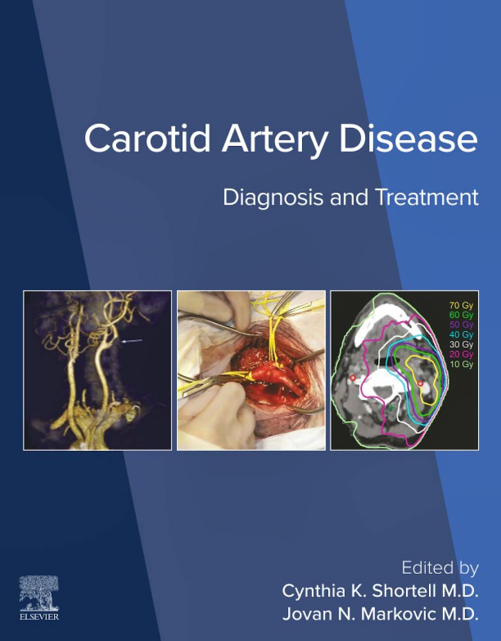 Portada del libro 9780443138652 Carotid Artery Disease. Diagnosis and Treatment