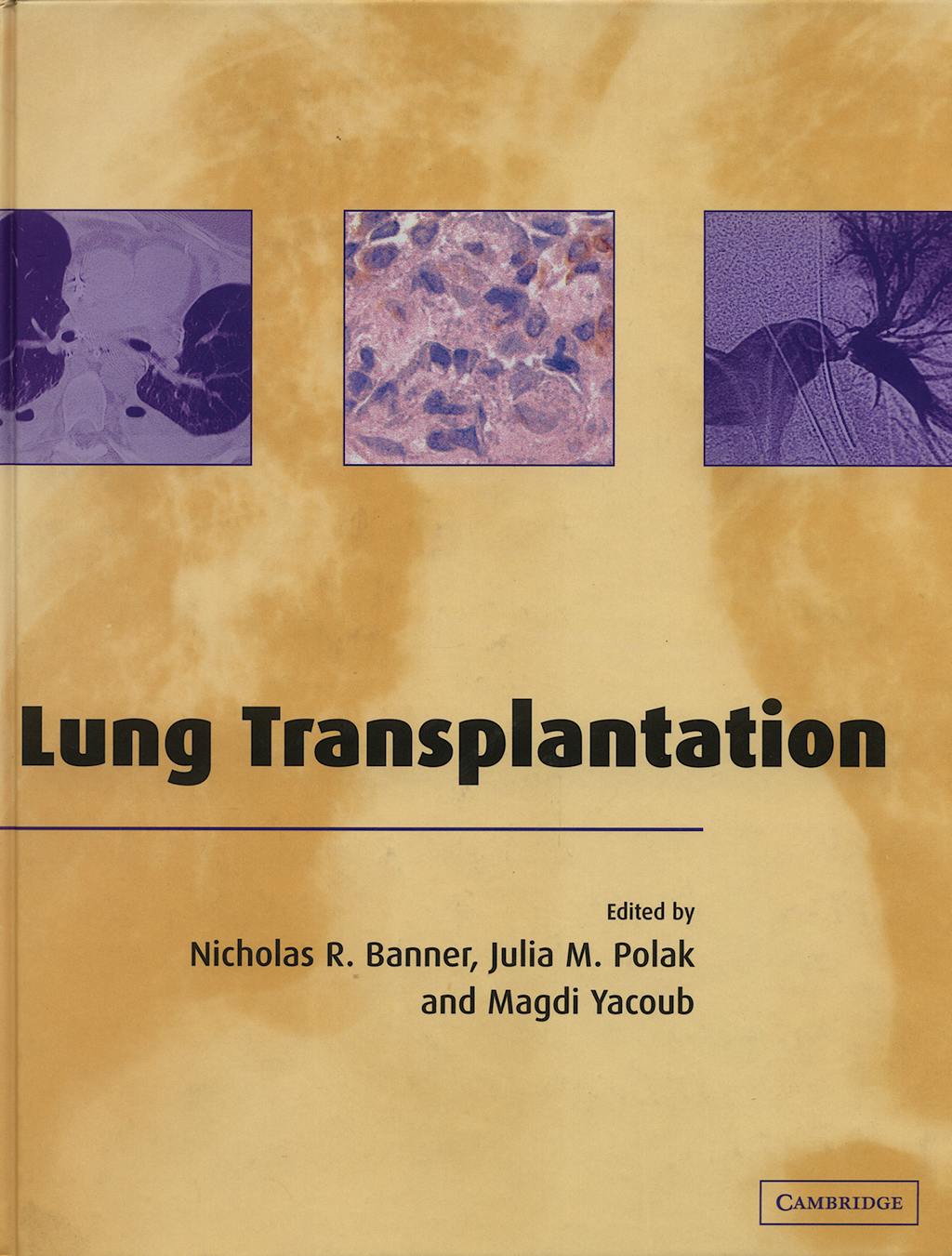 Portada del libro 9780521651110 Lung Transplantation