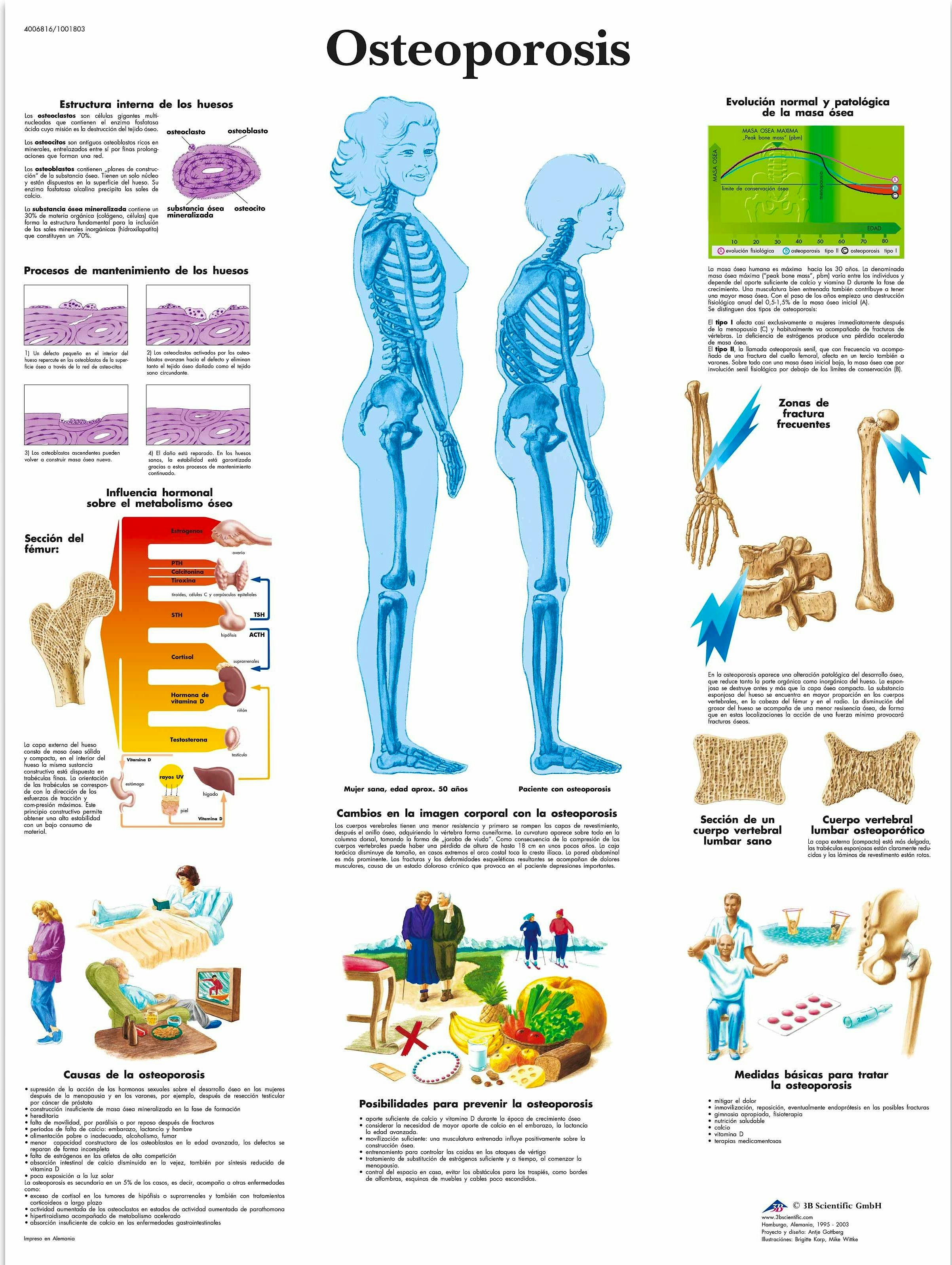 Lámina Osteoporosis (formato 50 x 67 cm.)