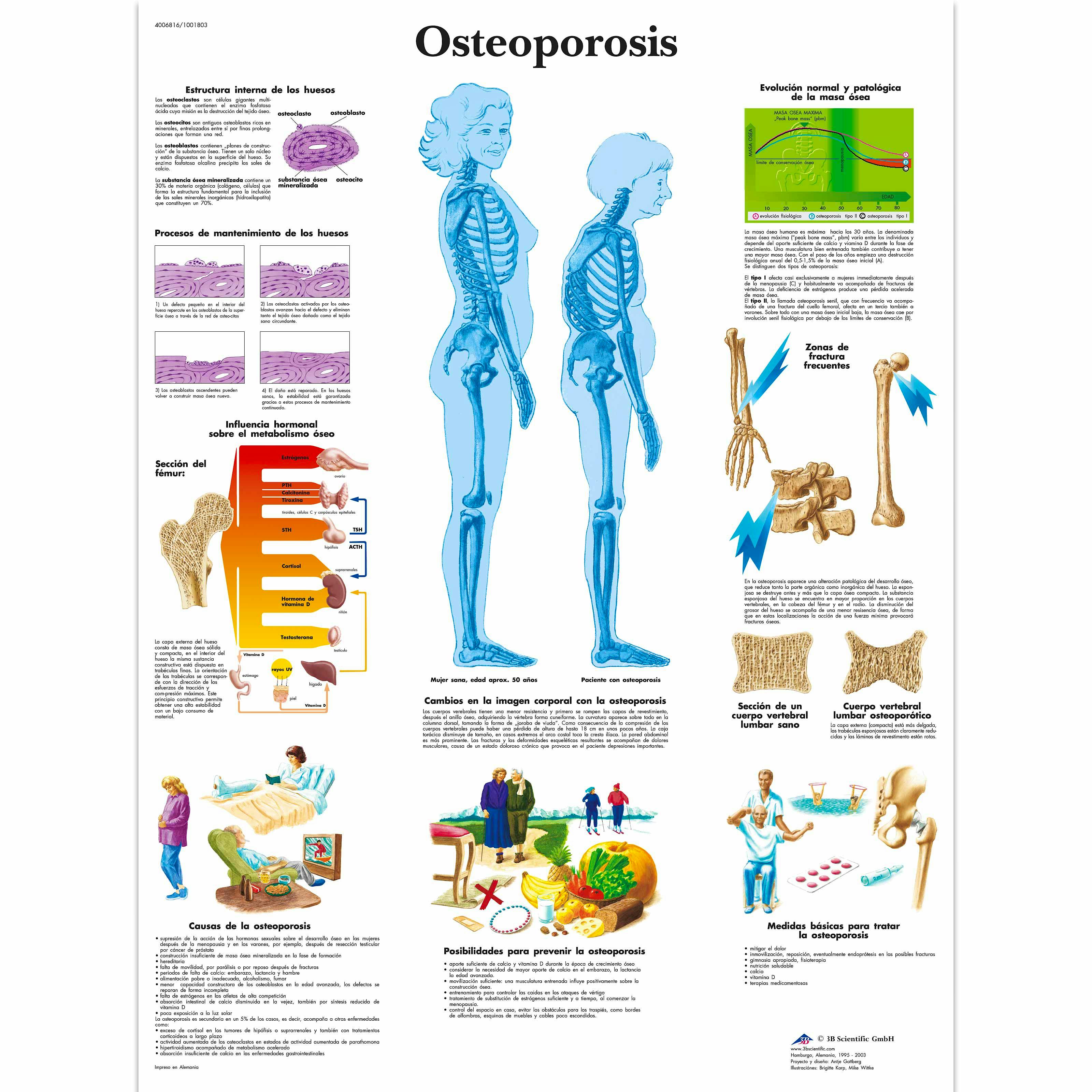Lámina Osteoporosis (formato 50 x 67 cm.)