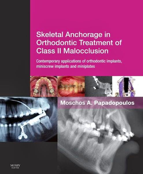 Portada del libro 9780723436492 Skeletal Anchorage in Orthodontic Treatment of Class II Malocclusion. Contemporary Applications of Orthodontic Implants, Miniscrew Implants and…