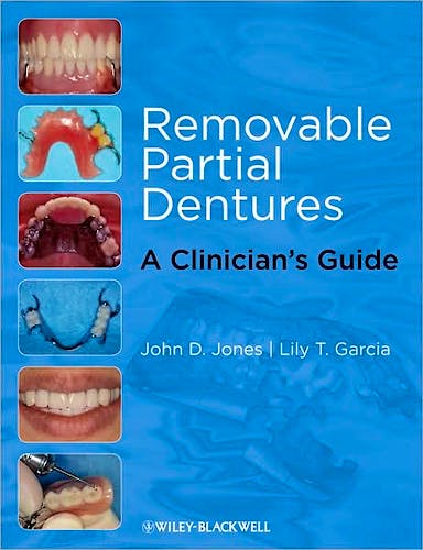 Removable Partial Dentures. A Clinician's Guide