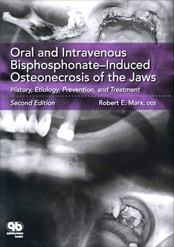 Portada del libro 9780867155105 Oral and Intravenous Bisphosphonate–Induced Osteonecrosis of the Jaws. History, Etiology, Prevention, and Treatment