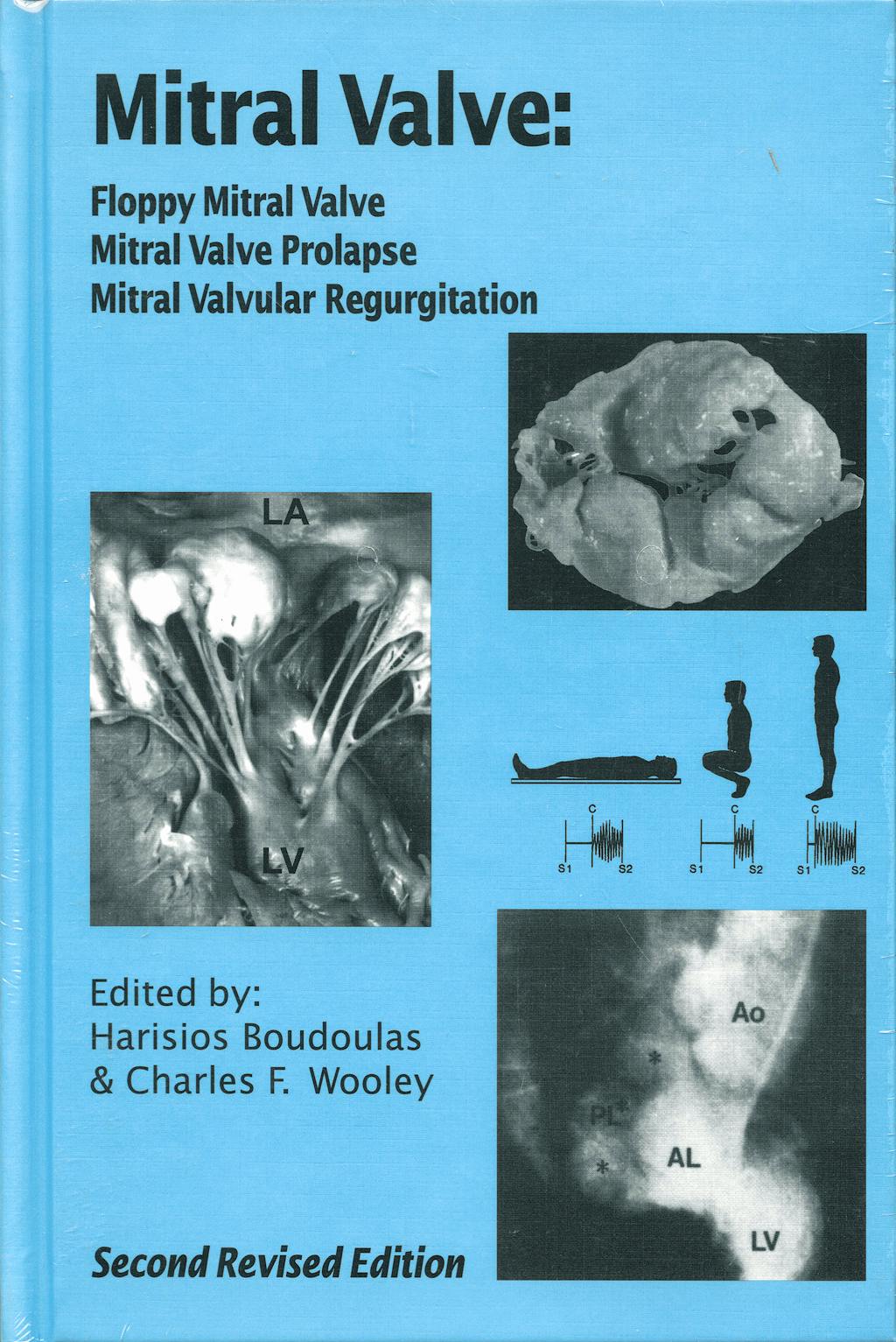 Portada del libro 9780879934484 Mitral Valve: Floppy Mitral Valve, Mitral Valve Prolapse, Mitral Valvular Regurgitation