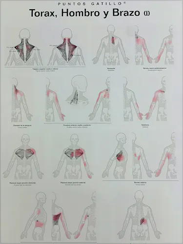 Lámina Puntos Gatillo: Tórax, Hombro y Brazo (I)