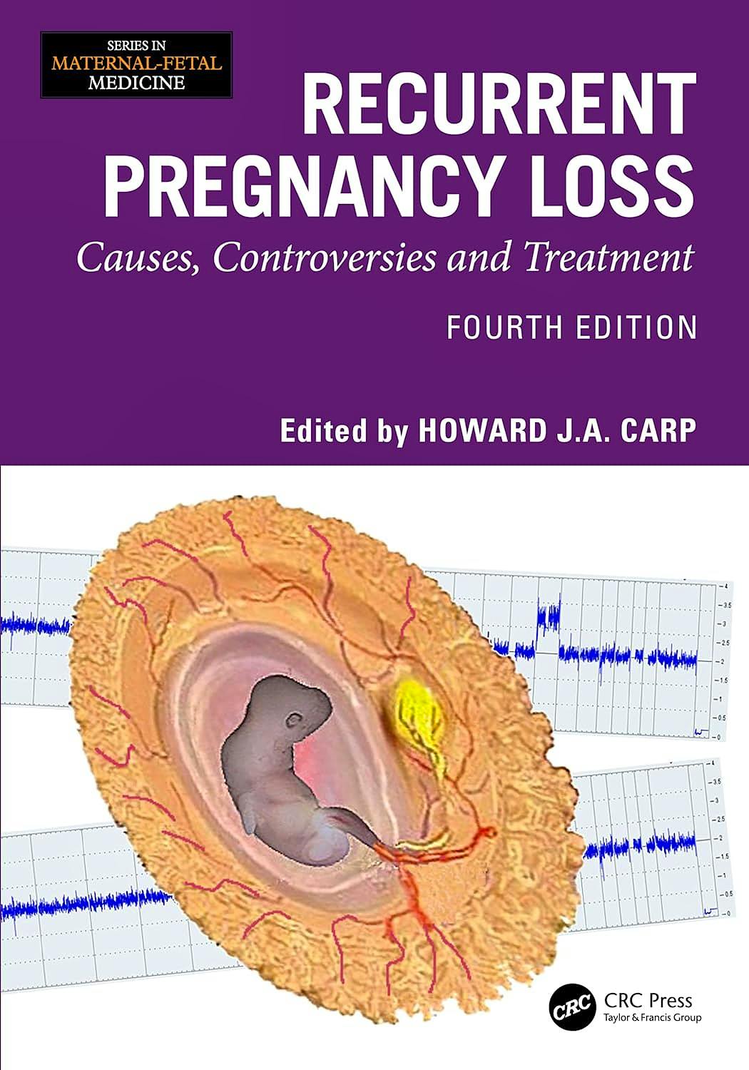 Portada del libro 9781032825243 Recurrent Pregnancy Loss. Causes, Controversies and Treatment