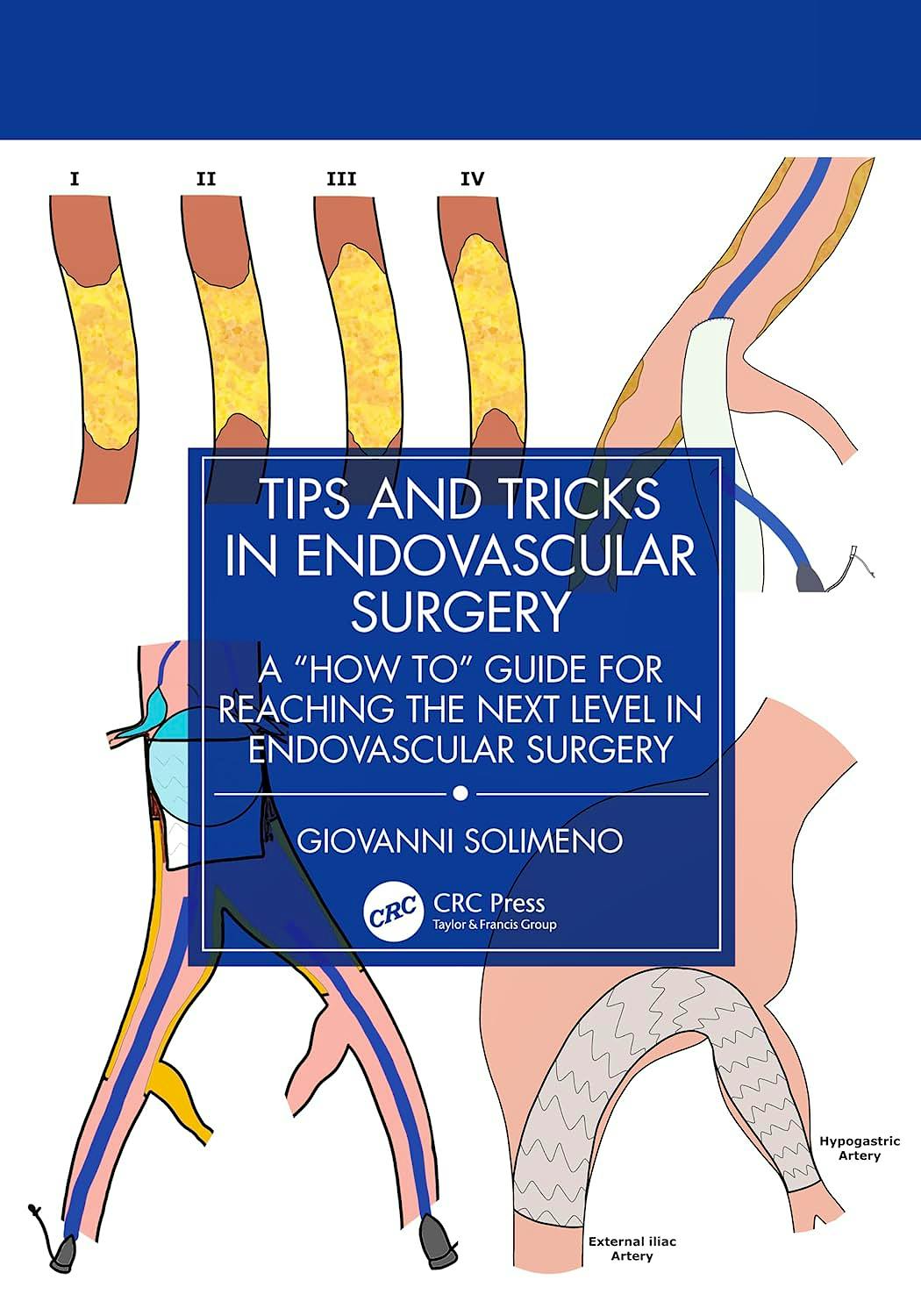 Portada del libro 9781032936710 Tips and Tricks in Endovascular Surgery. A "How to" Guide for Reaching the Next Level in Endovascular Surgery