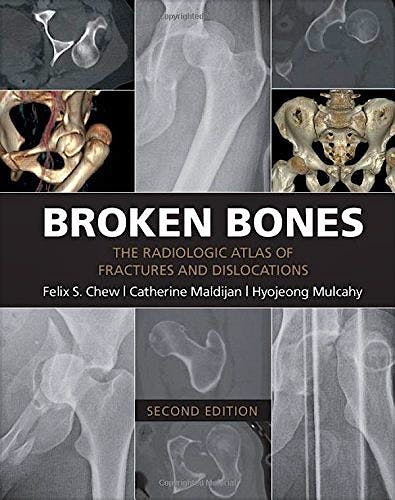 Portada del libro 9781107499232 Broken Bones. the Radiologic Atlas of Fractures and Dislocations