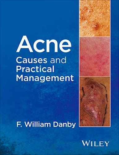 Acne. Causes and Practical Management