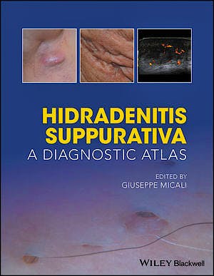 Portada del libro 9781119272953 Hidradenitis Suppurativa: A Diagnostic Atlas