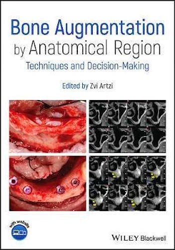 Bone Augmentation by Anatomical Region. Techniques and Decision-Making