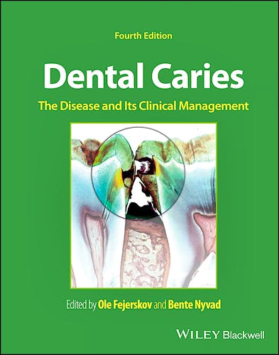 Portada del libro 9781119679370 Dental Caries. The Disease and Its Clinical Management