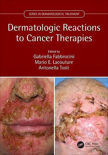 Portada del libro 9781138035539 Dermatologic Reactions to Cancer Therapies