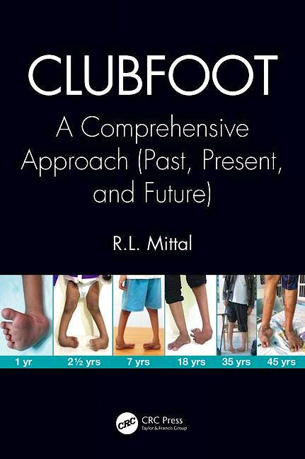 Portada del libro 9781138083738 Clubfoot. A Comprehensive Approach (Past, Present, and Future)