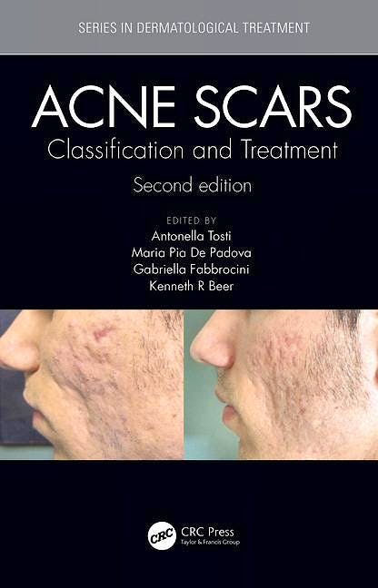 Portada del libro 9781138894228 Acne Scars. Classification and Treatment