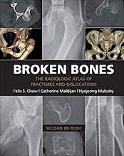 Broken Bones. the Radiologic Atlas of Fractures and Dislocations