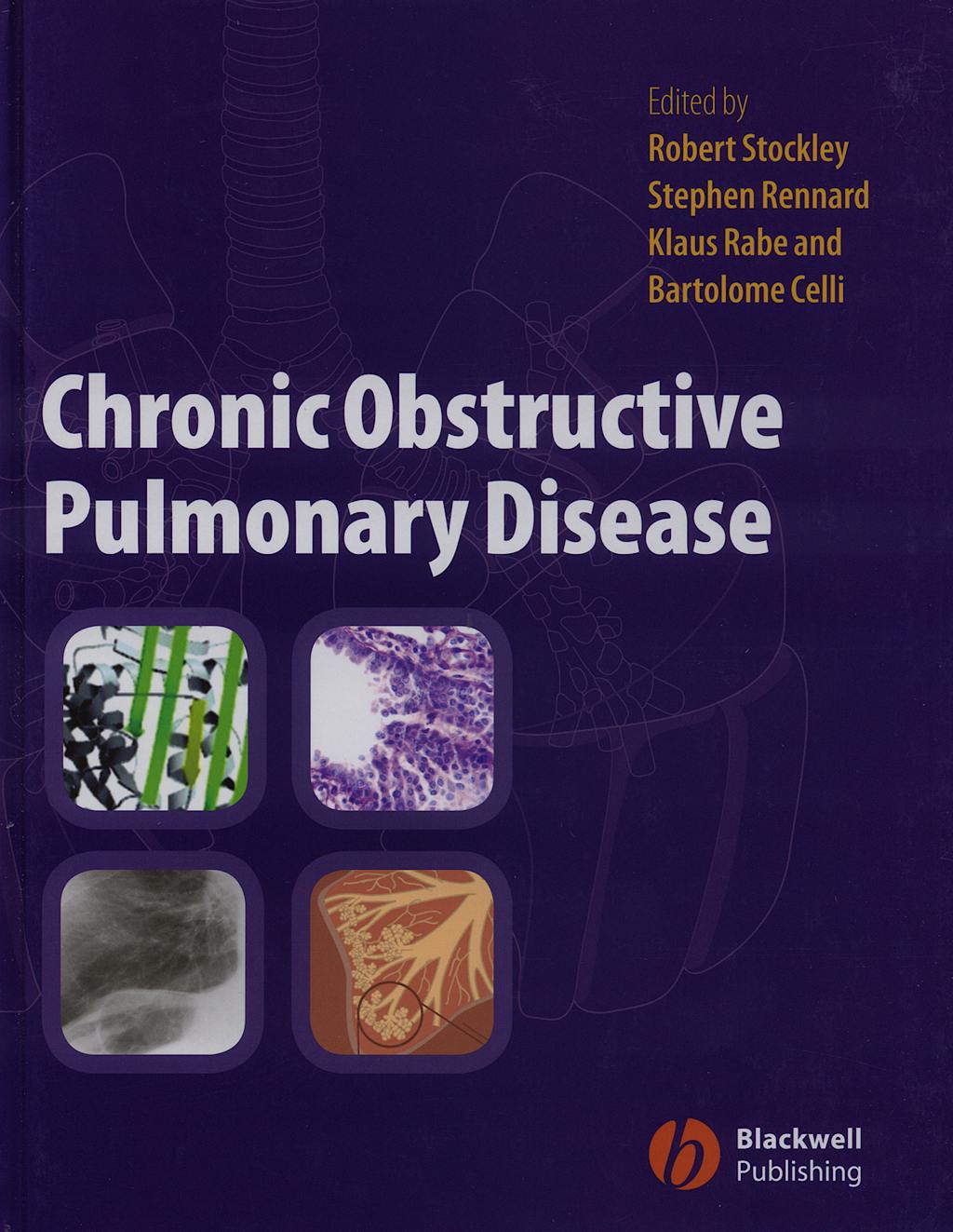 Portada del libro 9781405122894 Chronic Obstructive Pulmonary Disease