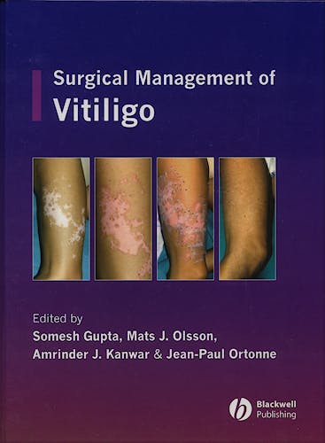 Portada del libro 9781405145213 Surgical Management of Vitiligo