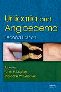 Portada del libro 9781420077841 Urticaria and Angioedema
