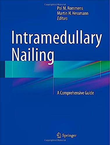 Portada del libro 9781447166115 Intramedullary Nailing. a Comprehensive Guide