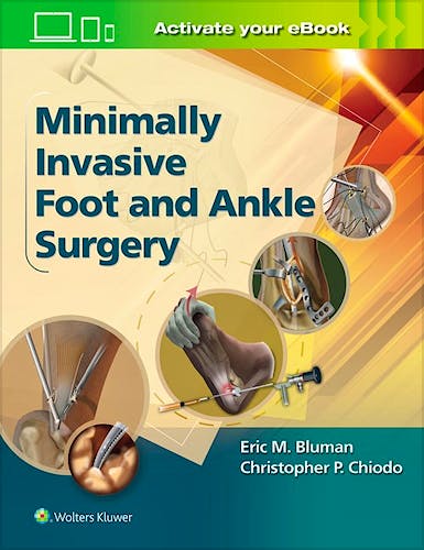 Portada del libro 9781451131611 Minimally Invasive Foot and Ankle Surgery