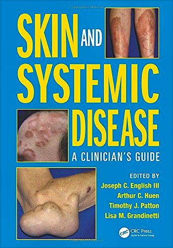 Portada del libro 9781482221589 Skin and Systemic Disease: A Clinician’s Guide