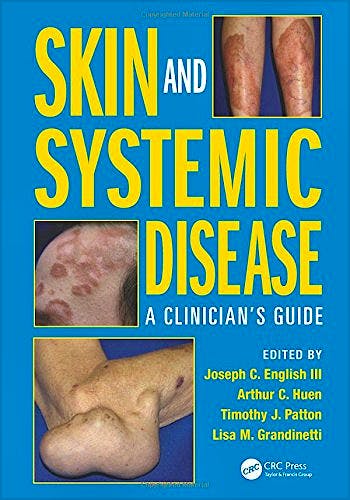 Portada del libro 9781482221589 Skin and Systemic Disease: A Clinician’s Guide