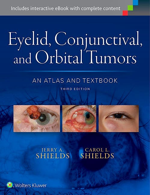 Portada del libro 9781496321480 Eyelid, Conjunctival and Orbital Tumors. An Atlas and Textbook