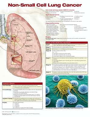 Non-Small Cell Lung Cancer (Anatomical Chart Company)