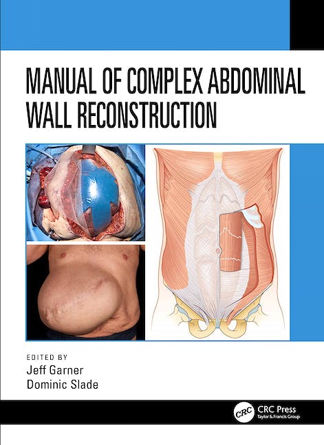 Portada del libro 9781498739467 Manual of Complex Abdominal Wall Reconstruction