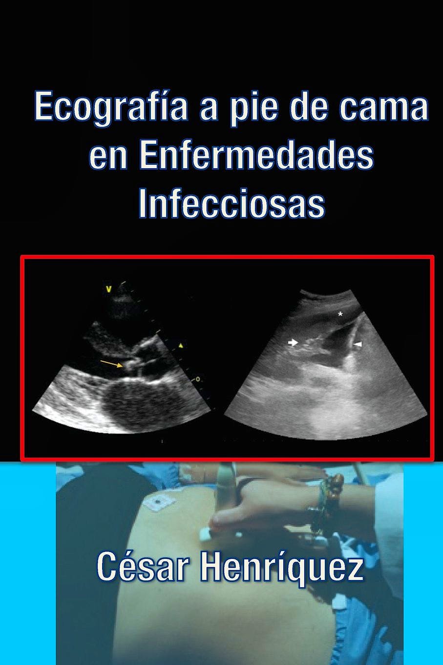Portada del libro 9781502594136 Ecografía a Pie de Cama en Enfermedades Infecciosas