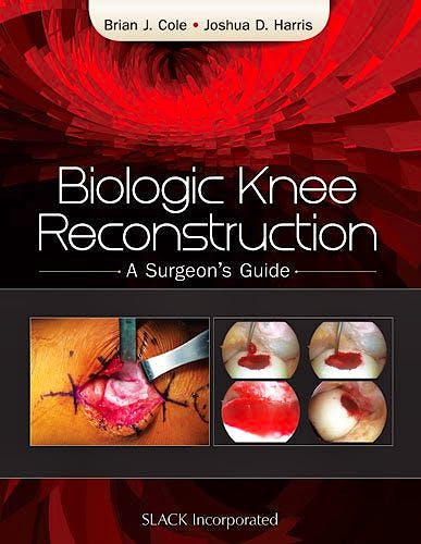 Portada del libro 9781617118166 Biologic Knee Reconstruction. a Surgeon's Guide