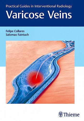 Portada del libro 9781626230125 Varicose Veins. Practical Guides in Interventional Radiology