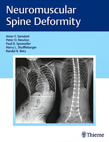 Portada del libro 9781626232600 Neuromuscular Spine Deformity