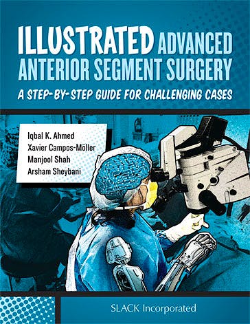 Portada del libro 9781630911843 Illustrated Advanced Anterior Segment Surgery. A Step-by-Step Guide for Challenging Cases
